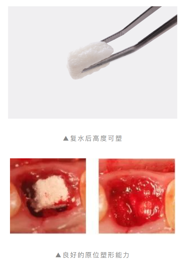 重磅上市！傲塑口腔颌骨骨再生产品 | 国内首款复合透明质酸天然骨填充材料