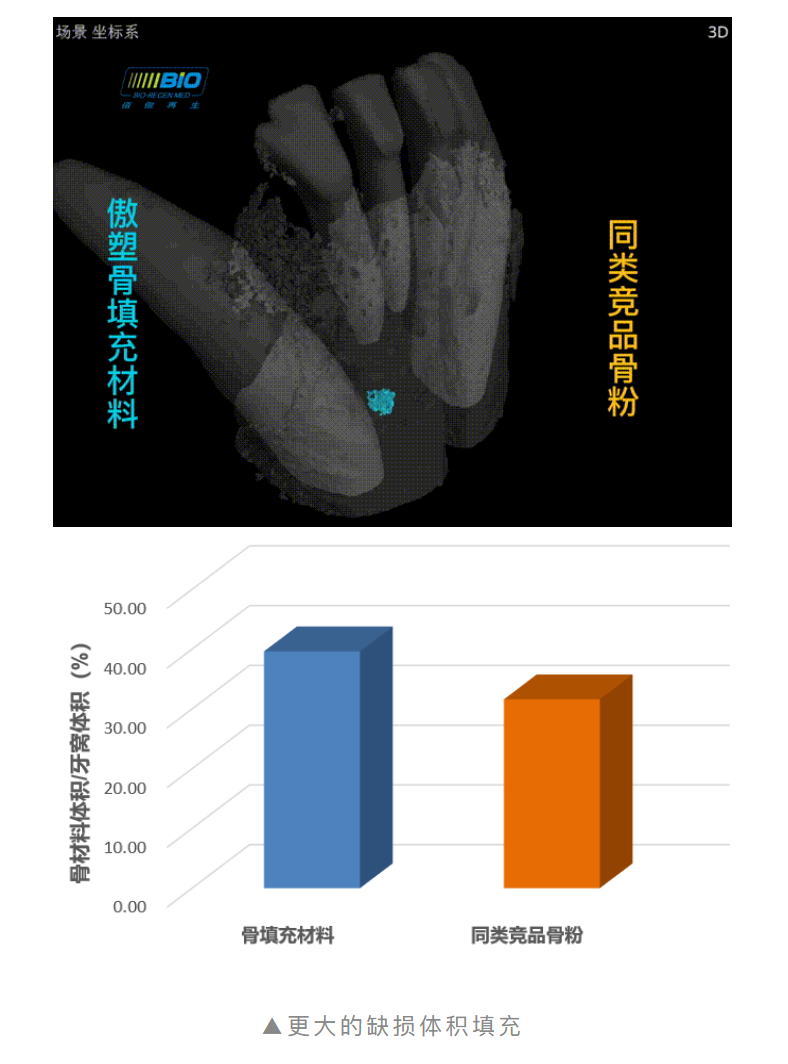 重磅上市！傲塑口腔颌骨骨再生产品 | 国内首款复合透明质酸天然骨填充材料